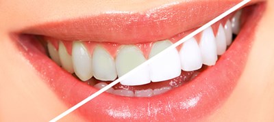 วิธีทำให้ฟันขาว 4 วิธี และสาระต่างๆ