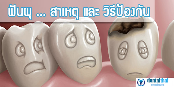 ฟันผุ สาเหตุ และ วิธีป้องกัน โดย ผู้เชี่ยวชาญ